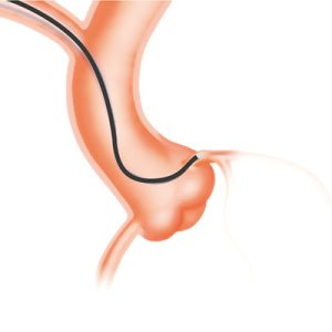 XCESS® Guiding Catheter